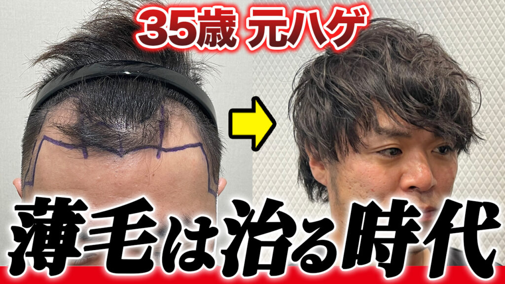 【植毛1年10ヶ月経過】どんどん後退していったM字ハゲ...諦めずに治療してついに克服！