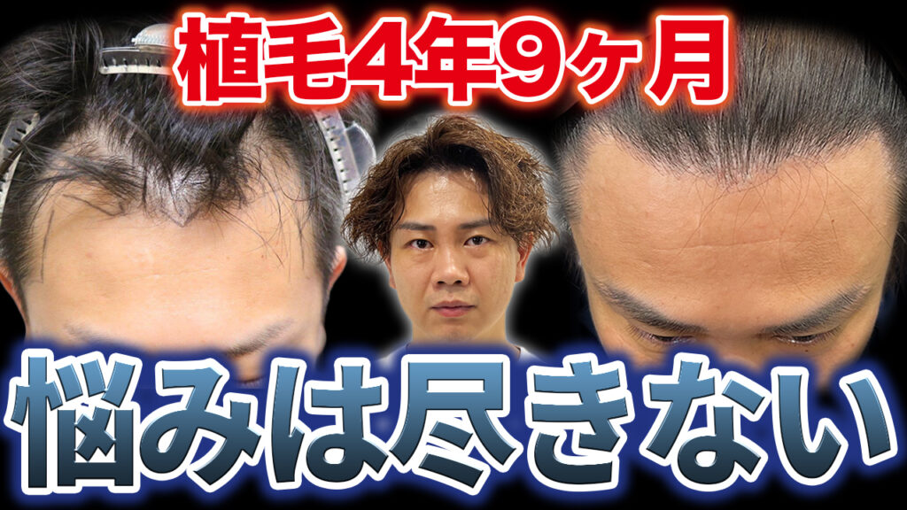 【30代薄毛】植毛して4年9ヶ月経過！悩みが多くてもう限界です...。