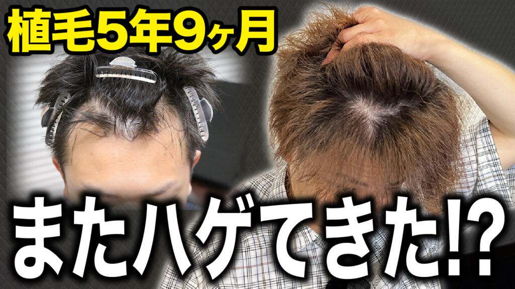 【大事なお願い】自毛植毛して5年9ヶ月経過した現状の状態！薄毛の悩みは終わらない…