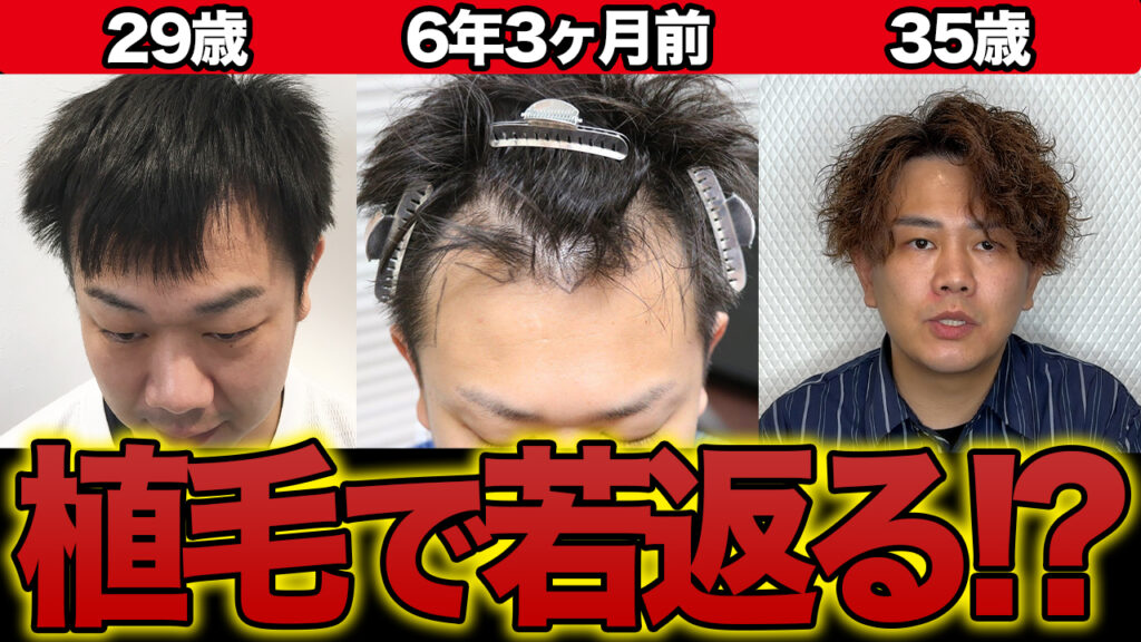 【若さ再び】ハゲで絶望を感じる人必見！植毛6年3ヶ月後の劇的な変化