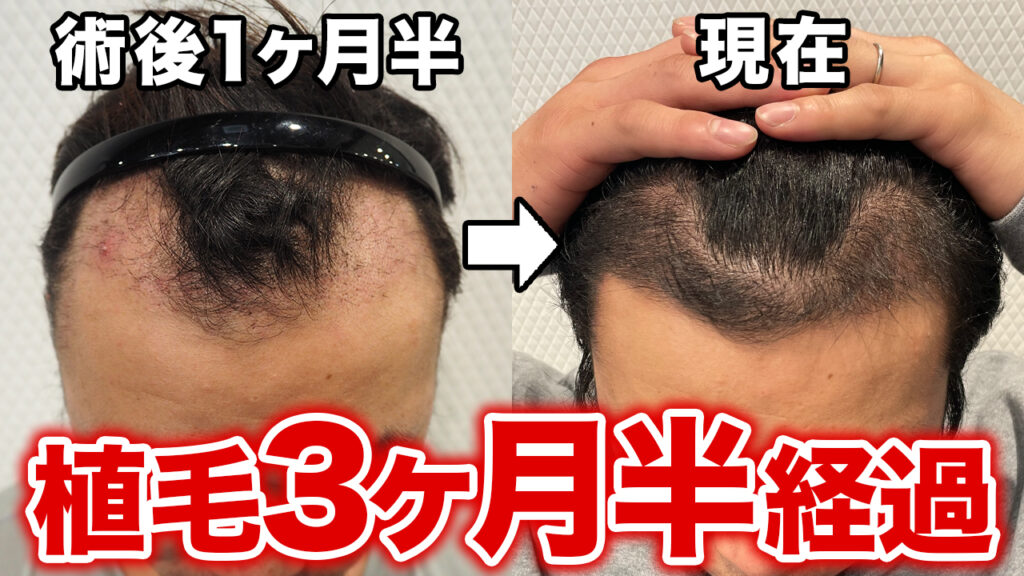 【植毛3ヶ月半】円形脱毛症はどうなった？薄毛が目立たない簡単ヘアセット！