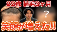 【薄毛に悩む20代】植毛から3ヶ月経って笑顔が増えました!!