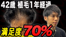 【自毛植毛】薄毛に悩み続けた40代メンズ。1年経過した完成系の状態を大公開