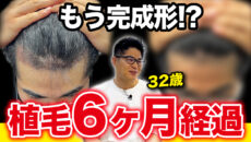 【大満足】20代前半からの薄毛悩み。植毛６ヶ月経過で笑顔が復活！