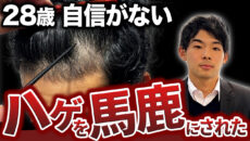 【初登場】薄毛が原因で辛すぎる経験をした28歳が植毛で人生を変えます！