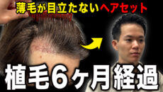 【20代M字ハゲ】地肌が透ける前髪をヘアセットでボリュームアップさせる！