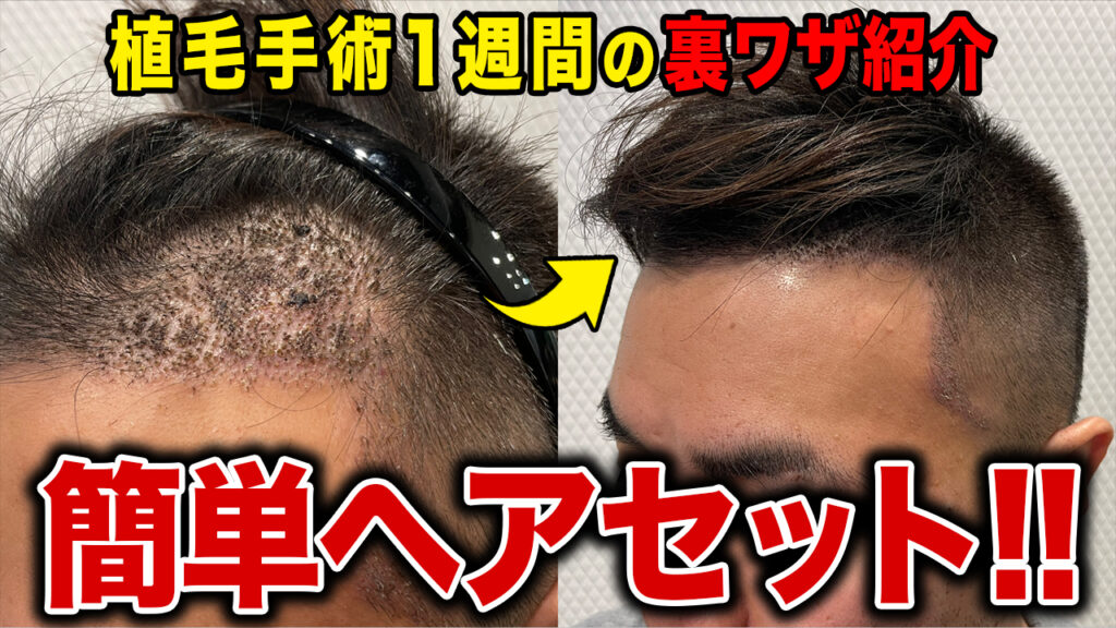 【誰でもできる】植毛手術1週間後のヘアセット！