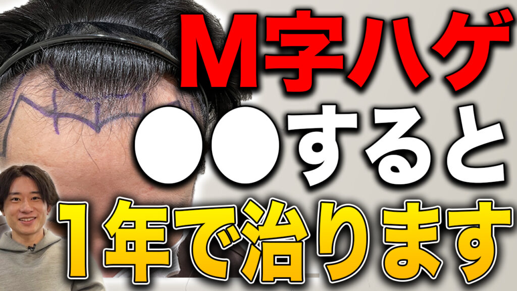 【祝1年経過】薄毛の悩みがなくなった！感動的な大変身をご覧ください【M字ハゲ】