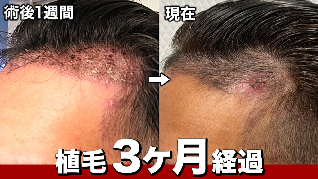 【植毛3ヶ月経過】手術後のヘアカラー！頭皮の赤みがまだ消えない！？