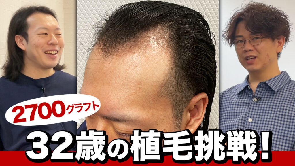 【M字ハゲ】30代男性の薄毛の悩みを改善するために過去最多の植毛に挑戦！