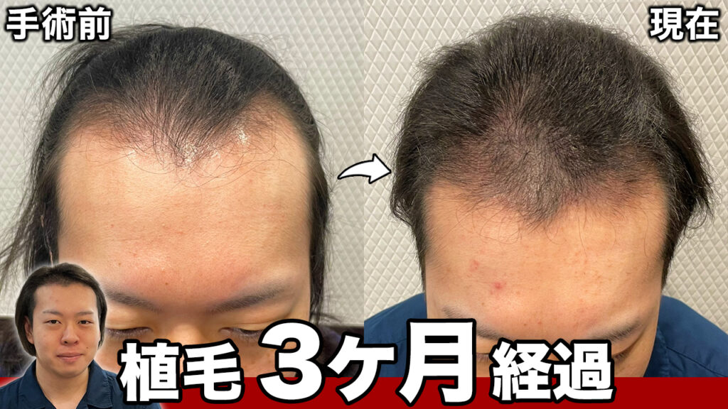 【30代薄毛】植毛から3ヶ月経過して少しずつ発毛を実感！状態の経過を比較