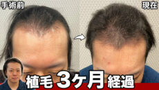 【30代薄毛】植毛から3ヶ月経過して少しずつ発毛を実感！状態の経過を比較