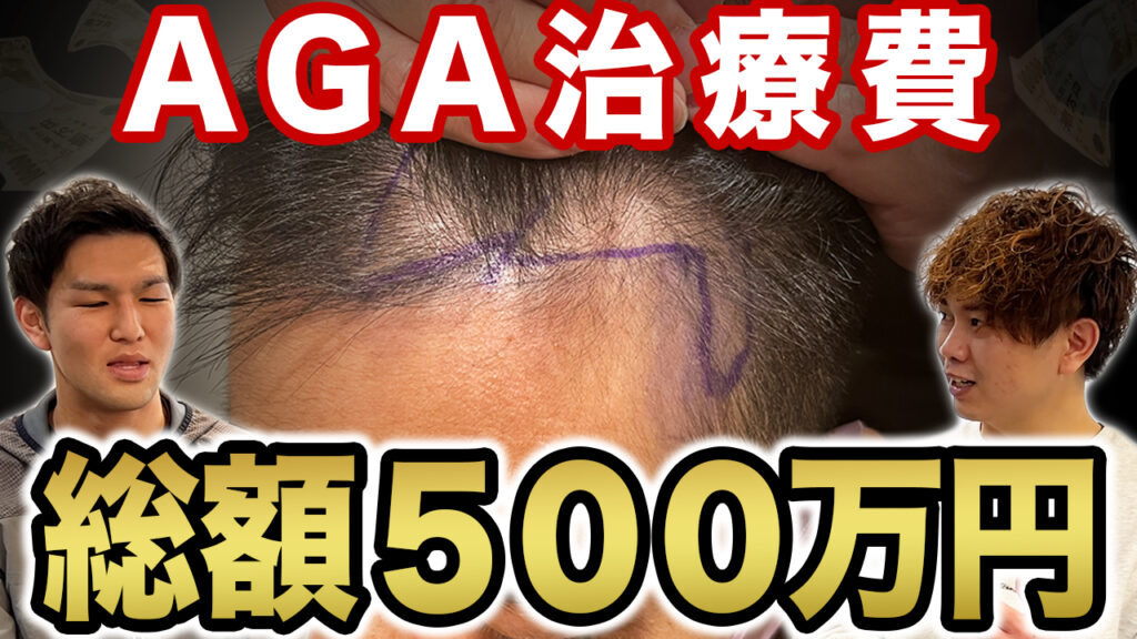 【驚きの過去】薄毛治療に総額500万円！？もっと早く植毛すれば良かった！