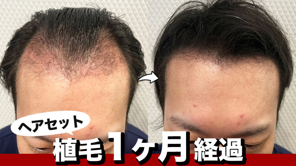 【薄毛改善】植毛1ヶ月経過した髪の状態とヘアセットのやり方！