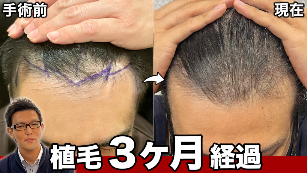 【植毛3ヶ月】抜け毛が辛い時期は増毛スプレーが大活躍！【薄毛ヘアセット】