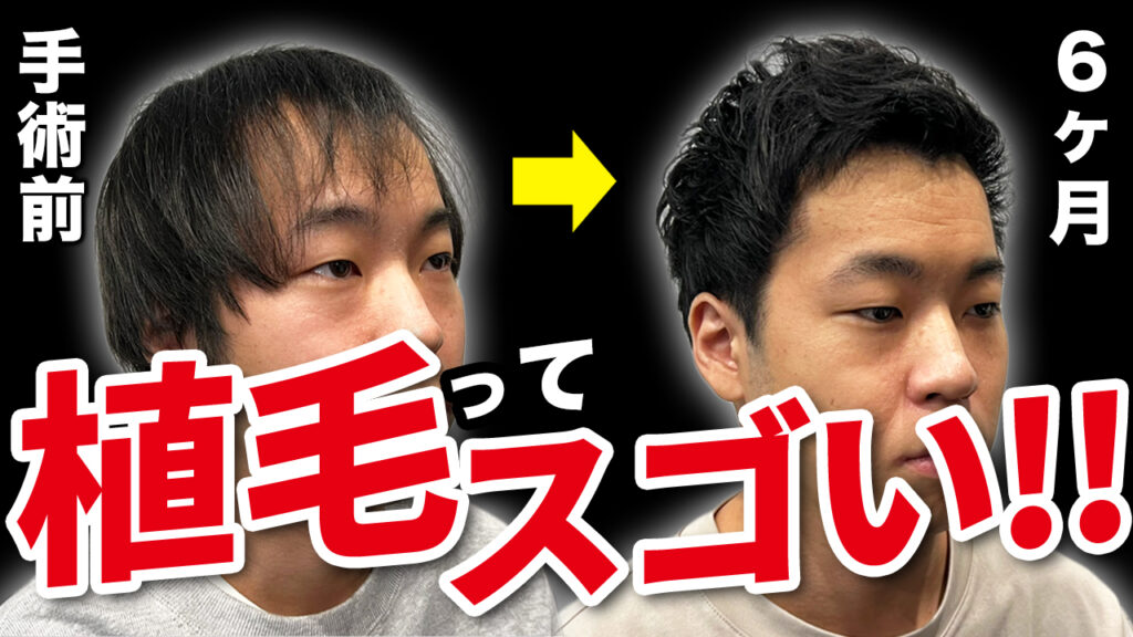 【薄毛に悩む30代】植毛から6ヶ月経過したら驚くべき変化が起きた！