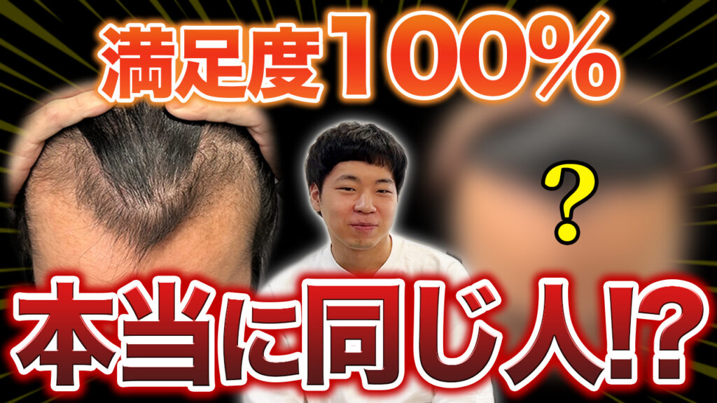 【驚愕の結果】植毛8ヶ月で満足度100％！？最高の仕上がりに感無量！