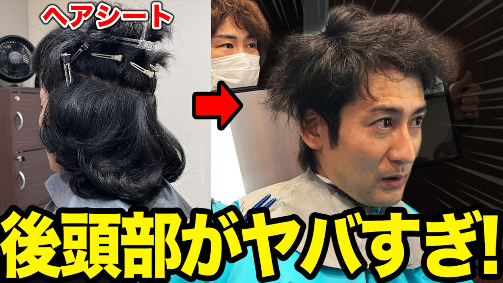 【植毛1ヶ月経過】ヘアシートは痛かった…メリットデメリット教えます！