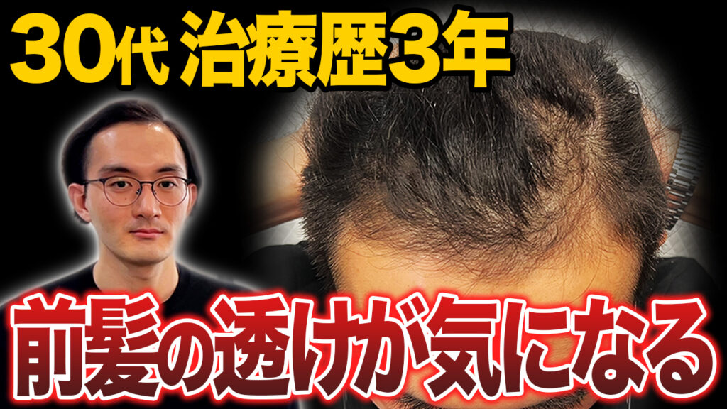 【初登場!!】AGA治療歴3年で限界を感じた...35歳が植毛に挑戦！【30代薄毛】