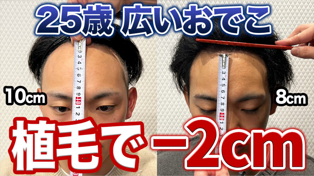 【20代 広いおでこ】植毛8ヶ月で薄毛のコンプレックスがなくなった！