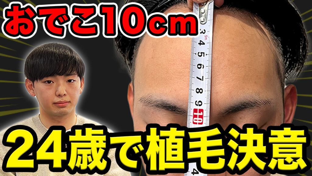 【初登場!!】高1からおでこが気になる24歳が植毛に挑戦！【20代薄毛】