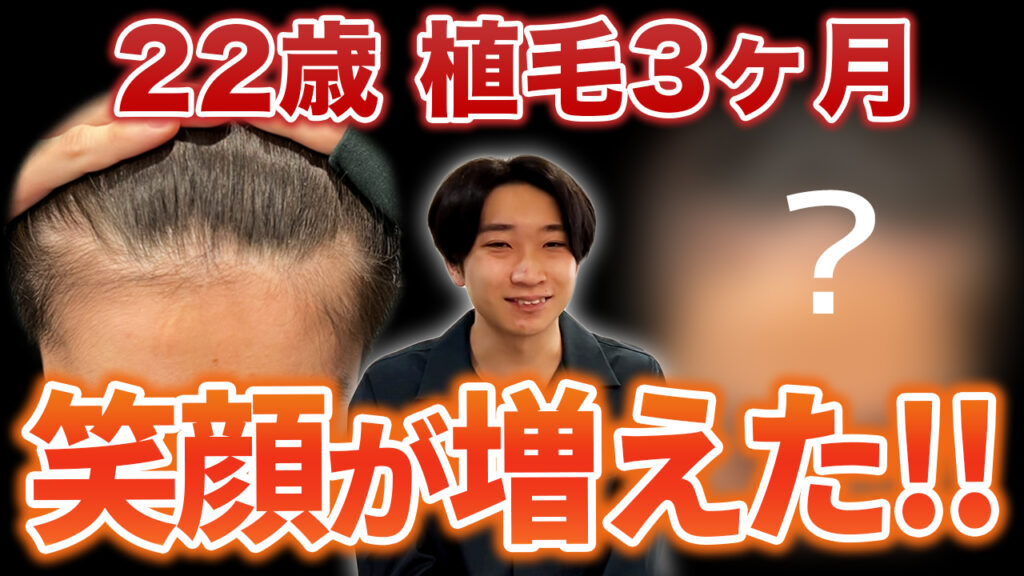 【薄毛に悩む20代】植毛から3ヶ月経って笑顔が増えました!!