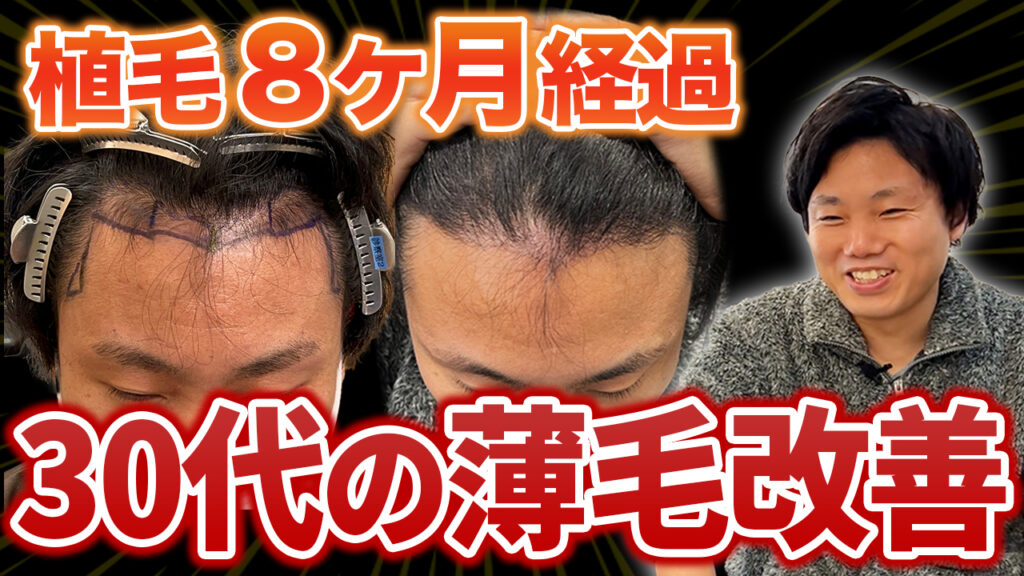 【30代植毛】抜け毛で不安だった暗黒期を乗り越えたら悩みがなくなった！【8ヶ月経過】