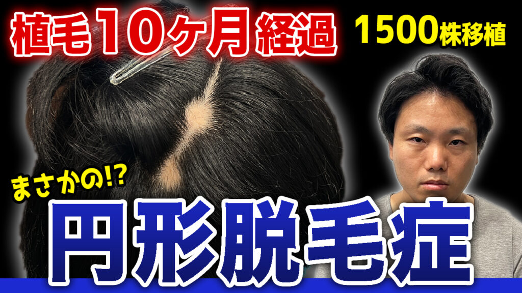 【植毛10ヶ月経過】円形脱毛症が発症して不安すぎる結果に...