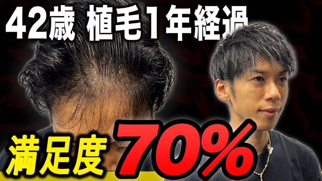 【自毛植毛】薄毛に悩み続けた40代メンズ。1年経過した完成系の状態を大公開