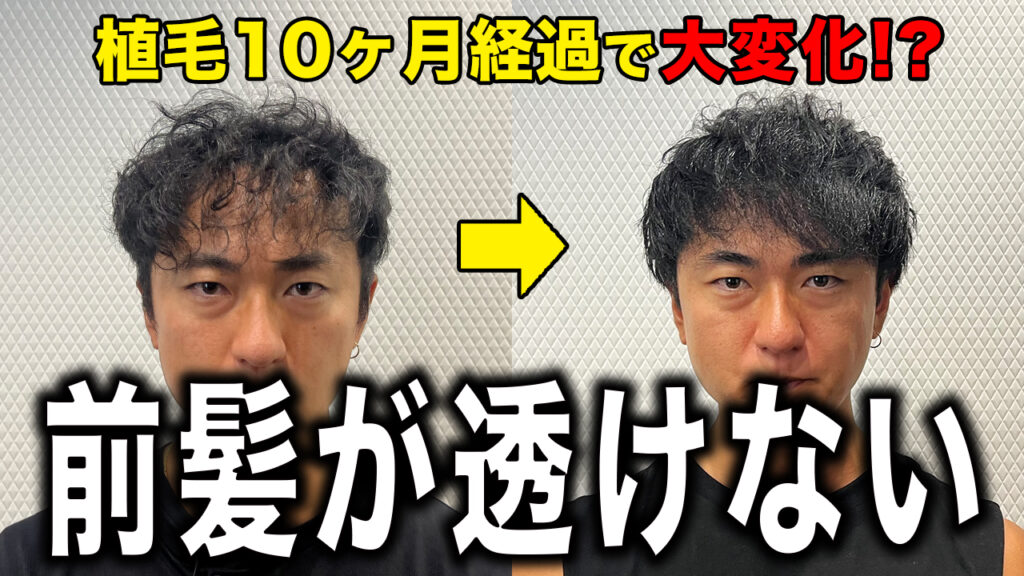 【30代薄毛】植毛10ヶ月経過して気になる前髪が透けなくなった！