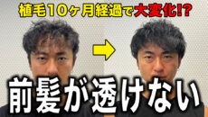 【30代薄毛】植毛10ヶ月経過して気になる前髪が透けなくなった！