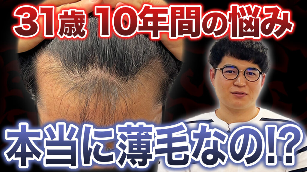 【初登場】10年間思い悩んだ薄毛事情。批判覚悟で植毛します！