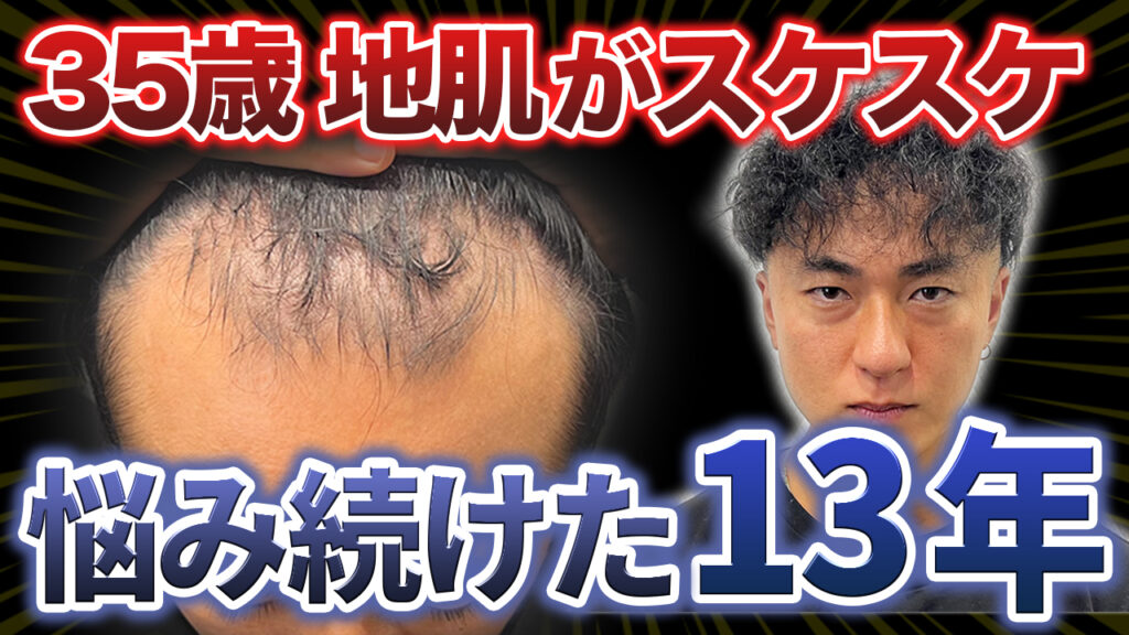 【初登場!!】13年間進行し続けた薄毛にケリをつける35歳！