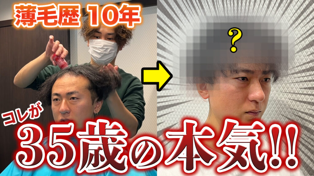 【薄毛の本気】植毛した35歳のヘアセット後が男前すぎた！！