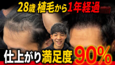 【祝1年経過】20代前半から薄毛に悩んで植毛した完成形がすごい!!