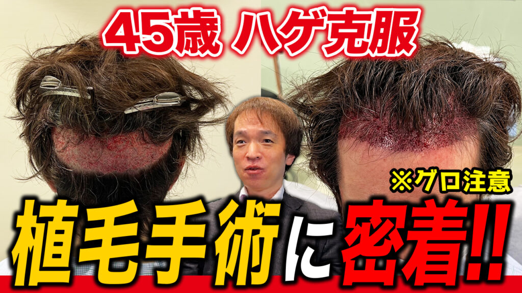 【自毛植毛】10年間悩み続けた薄毛を治すために40代男性が植毛手術に挑戦！