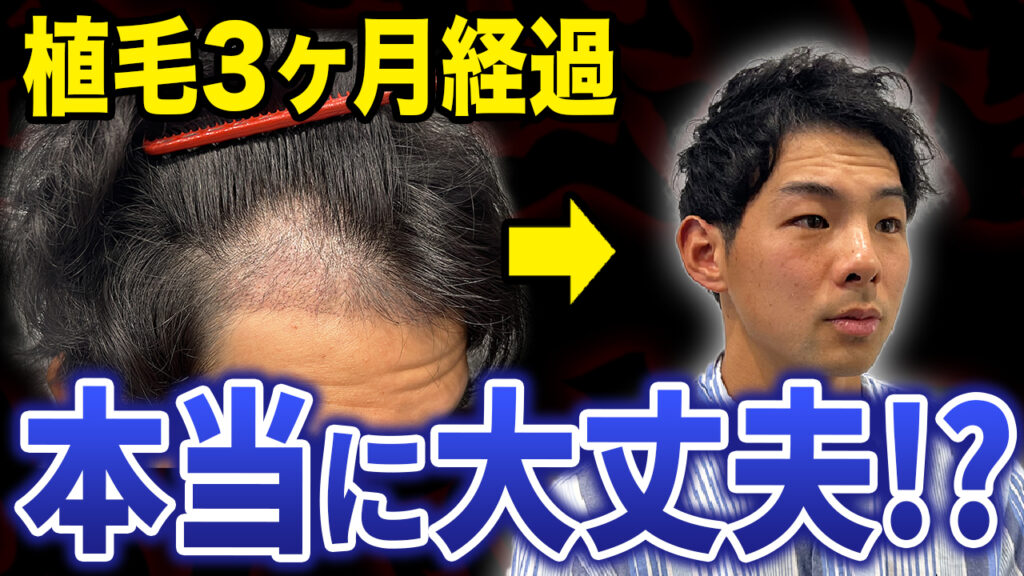 【不安】植毛から3ヶ月経過したのにショックロスがない！？