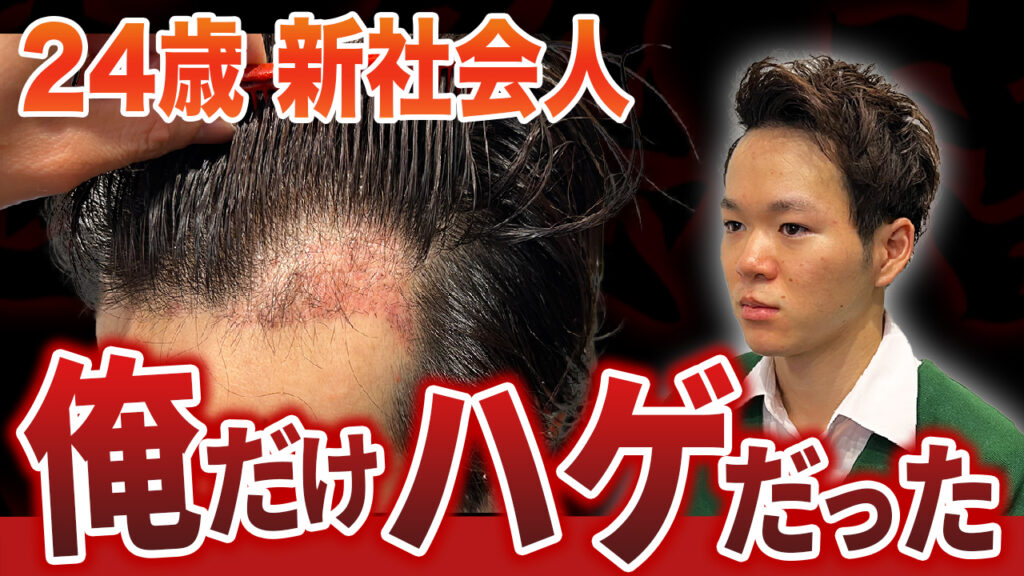 【絶望の状態】植毛1ヶ月経過の変化とヘアセットで自信を取り戻す方法