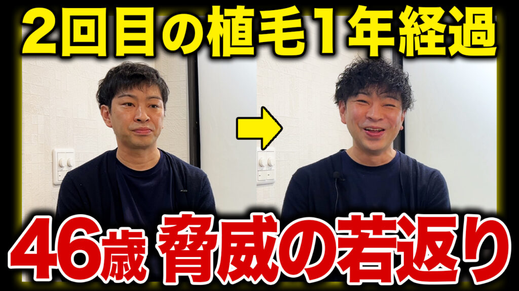 【−10歳若返り】40代の薄毛男性が2回目の植毛をして1年経過した姿が別人！