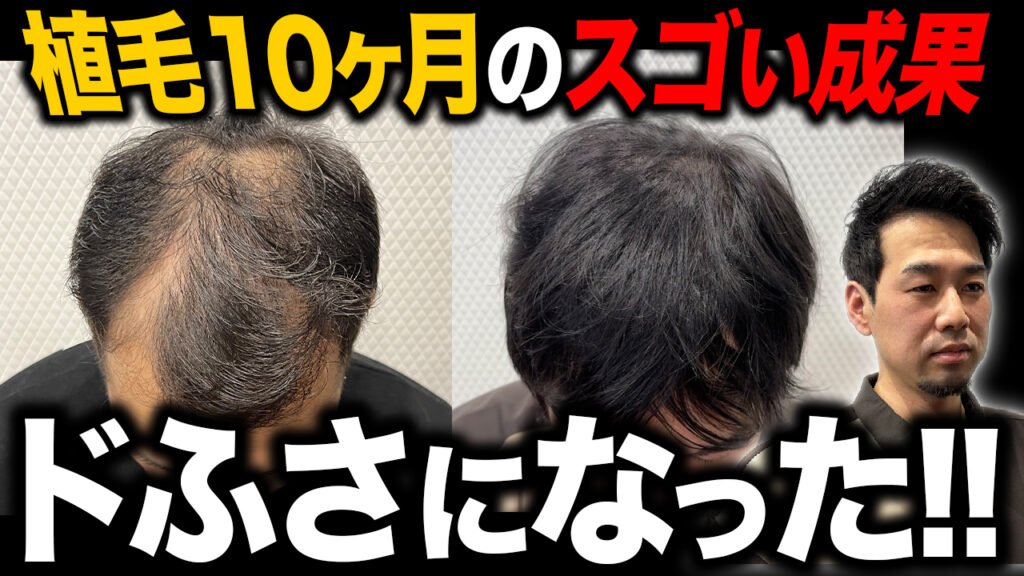 【植毛10ヶ月経過】薄毛の30代男性がフサフサの髪を取り戻す！