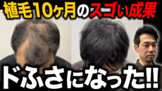 【植毛10ヶ月経過】薄毛の30代男性がフサフサの髪を取り戻す！