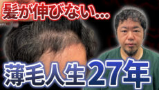 【初登場】薄毛部位の髪が伸びない!?植毛を決意した40代メンズの挑戦！