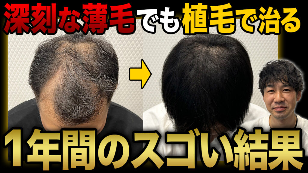 【衝撃の変身】深刻な薄毛だった30代男性が植毛して1年で別人に大変身！