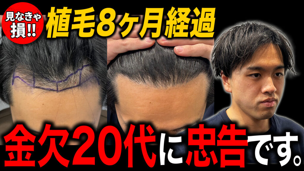 【若ハゲ】金欠で植毛できない20代がするべきこと！植毛8ヶ月経過の状態