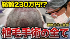 【植毛医にガチ相談】失敗したくないけど費用が不安…27年間薄毛に悩んできたメンズの最終決断とは？