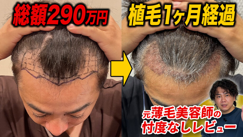 【植毛1ヶ月】3,000グラフト移植の現在は？ヘアシート外します