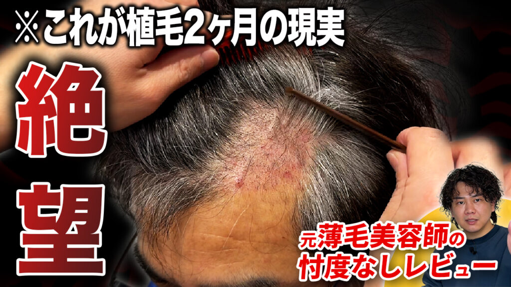 【植毛2ヶ月】頭皮が荒れる…植毛後のリアルな経過と増毛スプレーの使い方