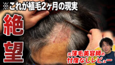 【植毛2ヶ月】頭皮が荒れる…植毛後のリアルな経過と増毛スプレーの使い方