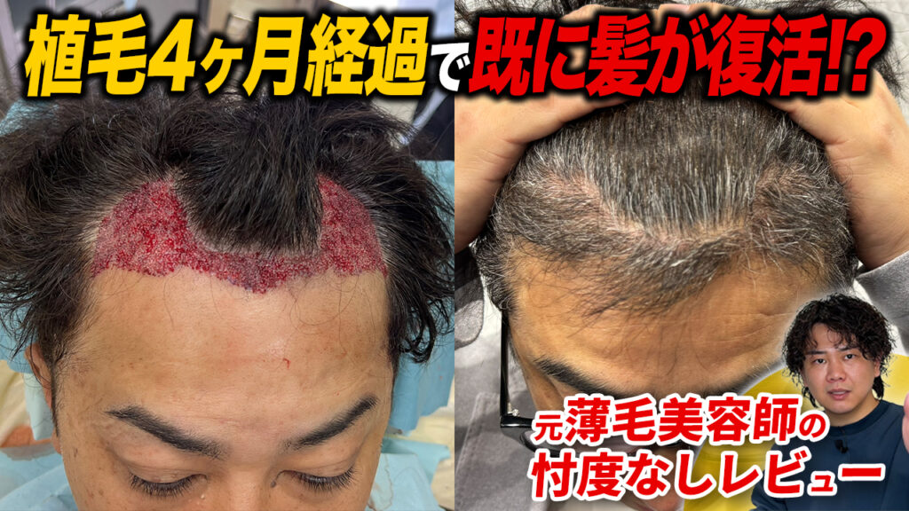 【植毛4ヶ月】劇的改善？現在の頭皮の状態！増毛スプレーはもう使っていません