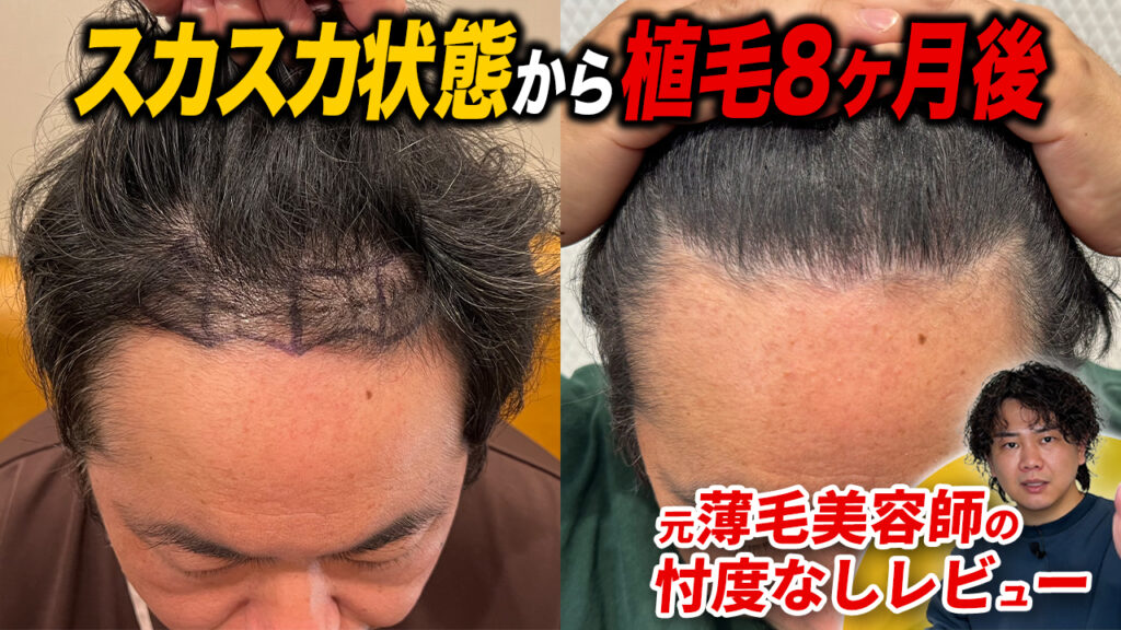 【植毛8ヶ月】ついに髪が伸びてきた！薬はいつまで飲む？